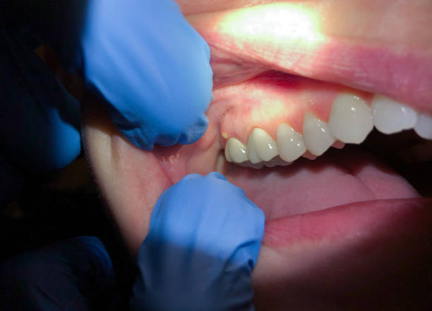 Best Knocked-Out Tooth (Avulsed Tooth) Treatment in Kingstowne, VA