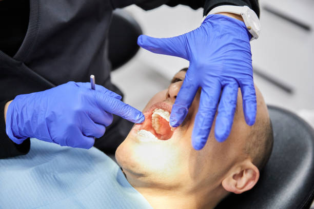 Best Emergency Wisdom Tooth Extraction in Kingstowne, VA